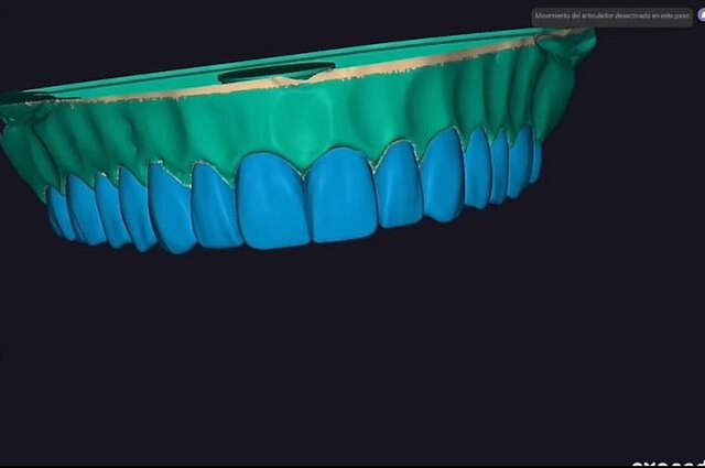 Teeth grillz and Dental restorations