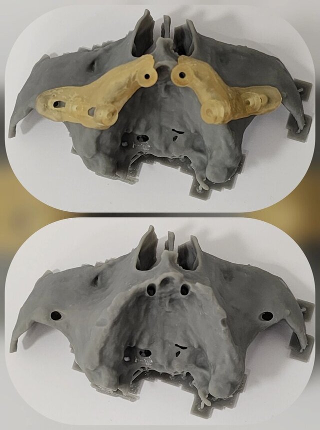 Guide for zygomatic implants