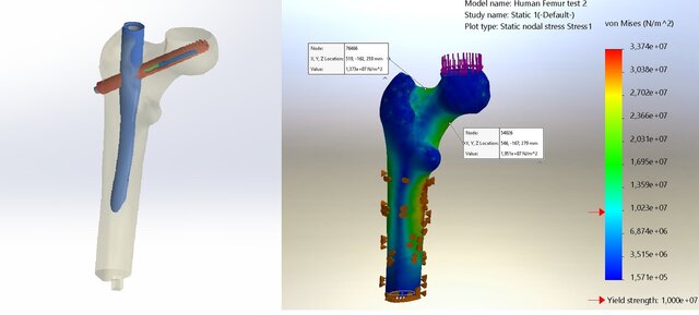 Human Femur Implant FEA Study