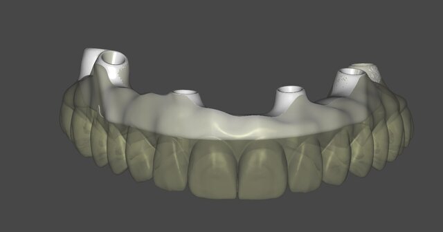 Full-Arch Implant Prosthesis on Titanium Bar (Dental CAD/CAM)