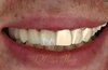 Full Upper Jaw Rehabilitation design by dthamzaeminovic