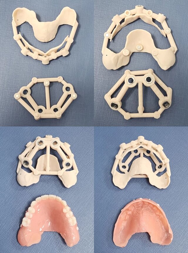 Stackable guide for guided implant