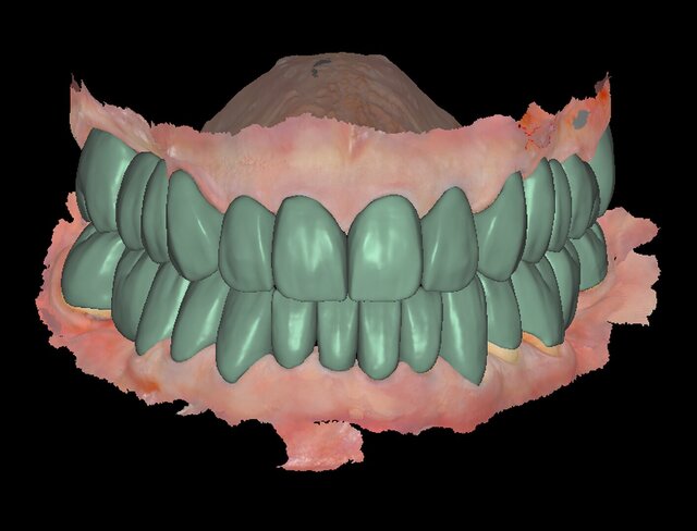 3D model of Exocad designs