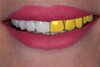 Full Uper Jaw Rehabilitation design by dthamzaeminovic