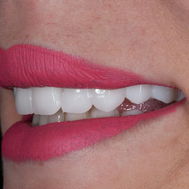 3D model of Full Uper Jaw Rehabilitation