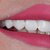 Full Uper Jaw Rehabilitation