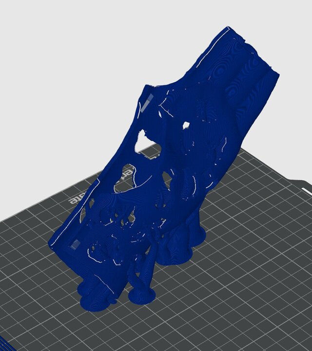 3D model of Custom 3D-Printed Orthosis from 3D Scan for a Child’s Hand (Left Hand)