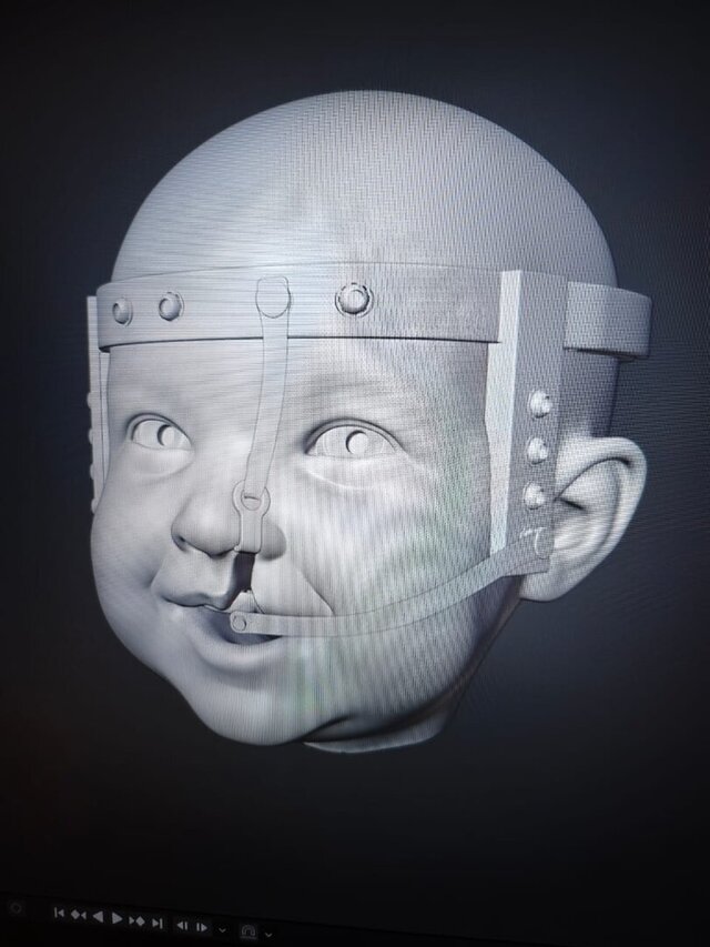 Cleft Baby Medical Device