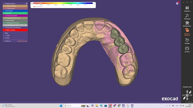 Dental Bridge Design