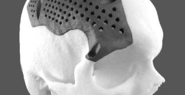 Cranial implant by Alvise Rizzo on Cad Crowd