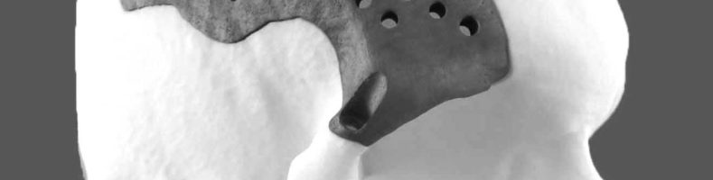 Cranial implant by Alvise Rizzo on Cad Crowd