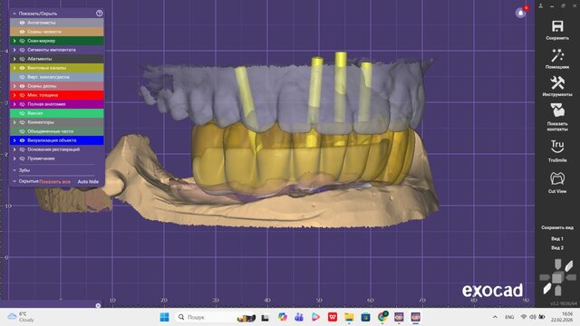 I offer professional dental CAD design (Exocad) for crowns, veneers & implants image 5