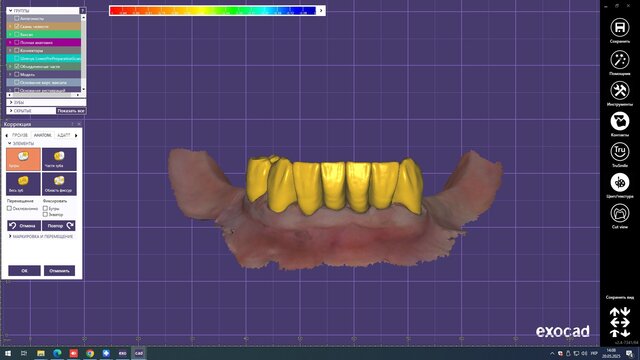 I offer professional dental CAD design (Exocad) for crowns, veneers & implants image 7