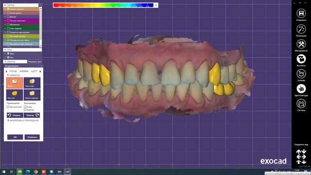 I offer professional dental CAD design (Exocad) for crowns, veneers & implants image 4