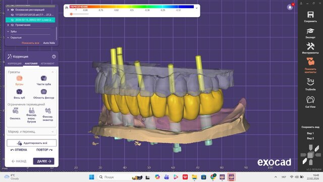 I offer professional dental CAD design (Exocad) for crowns, veneers & implants image 9