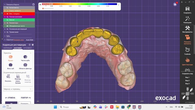 I offer professional dental CAD design (Exocad) for crowns, veneers & implants image 10