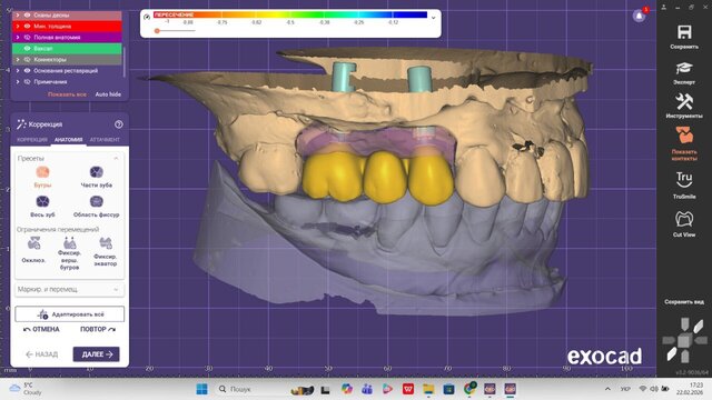 I offer professional dental CAD design (Exocad) for crowns, veneers & implants