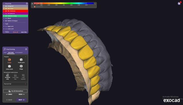 I will design professional Exocad dental restorations, implant cases and full arch workflows image 9