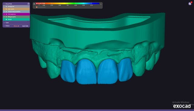 I will design professional Exocad dental restorations, implant cases and full arch workflows image 11