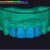 I will design professional Exocad dental restorations, implant cases and full arch workflows slider nav image 11