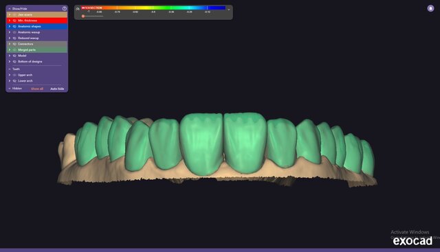 I will design professional Exocad dental restorations, implant cases and full arch workflows image 6