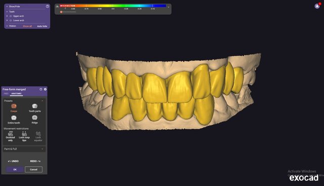 I will design professional Exocad dental restorations, implant cases and full arch workflows image 4