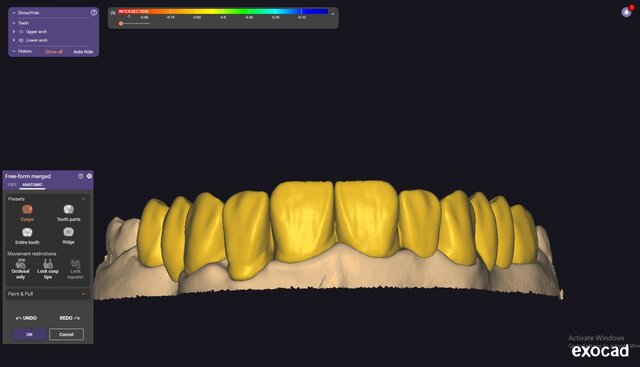 I will design professional Exocad dental restorations, implant cases and full arch workflows image 5