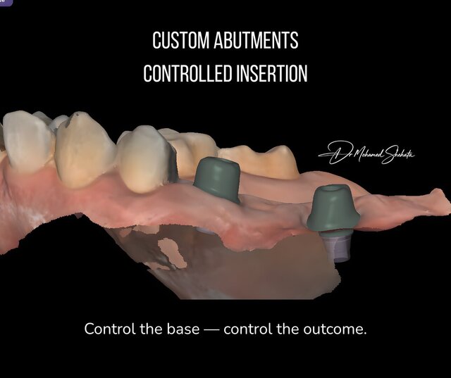 I will design professional Exocad dental restorations, implant cases and full arch workflows image 3