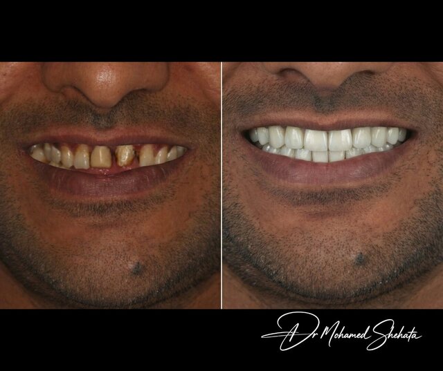 I will design professional Exocad dental restorations, implant cases and full arch workflows image 2