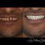 I will design professional Exocad dental restorations, implant cases and full arch workflows slider nav image 2